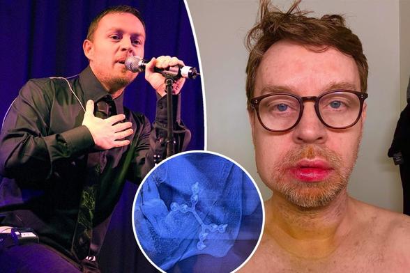 Darren Hayes from Savage Garden broke his jaw in 'terrible' accident