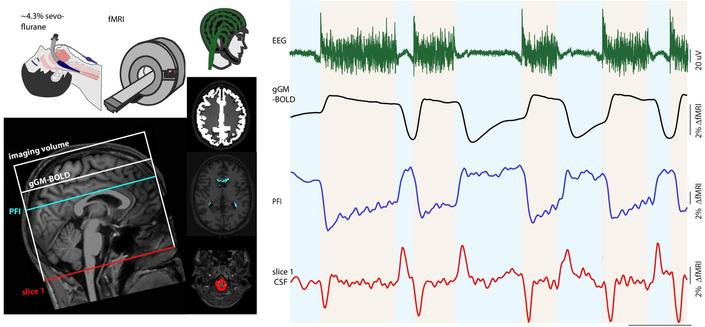 Coupled neuronal activity, gGM, PFI, and CSF fMRI signals during burst-suppression anesthesia. Top left: Experimental design: fMRI recording under deep sevoflurane anesthesia in a Philips Achieva 3.0T scanner. Bottom left: Example scan positioning in a representative subject. Schematic depiction of the fMRI volume superimposed on a sagittal T1-weighted image with representative slice positions for the gGM and PFI masks and slice 1, which contains the CSF mask. Middle: Simultaneous recordings of the EEG with an MRI-compatible, 64-electrode cap with equidistantly arranged electrodes (Easycap) and of three fMRI masks, depicted in representative slices: gGM (white), PFI (blue), and CSF (red). Right: Simultaneously recorded signal time courses from one subject under burst-suppression anesthesia: EEG (green), gGM fMRI (black), PFI fMRI (blue), and CSF fMRI (red). Suppression and burst periods are indicated in light blue and light orange, respectively.