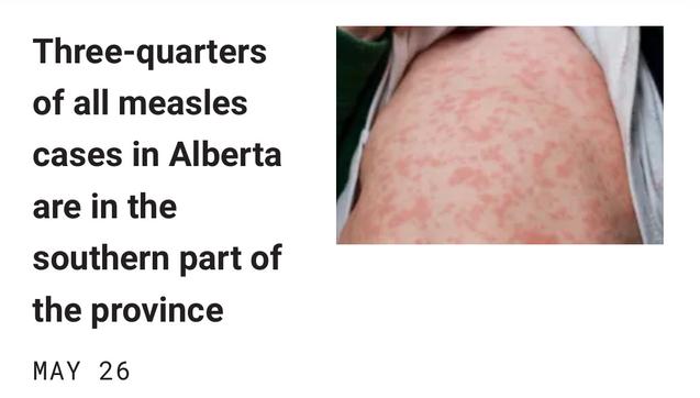 Three-quarters of all measles
cases in Alberta are in the southern part of
the province

MAY 26