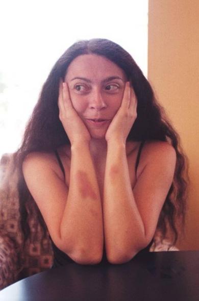 A person with long, dark, wavy hair sits at a table, resting their face on their hands with a surprised expression. Light streams in from a window, casting a warm glow. Their forearms have dark bruises.