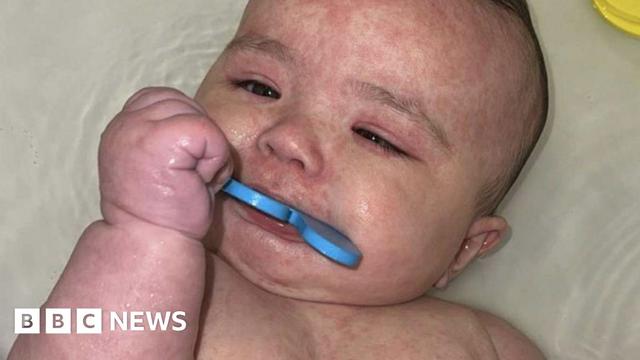A photo of Kimie with a visible red rash on her body, a common symptom of measles.